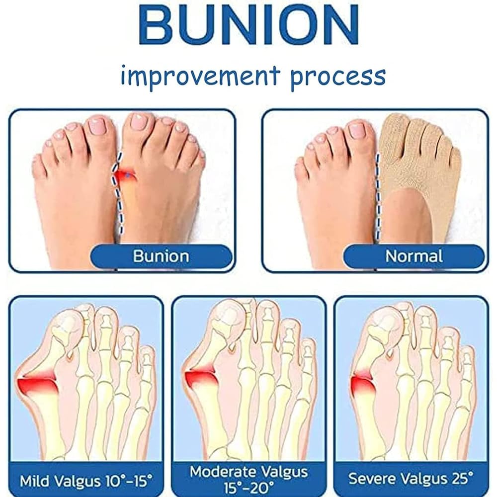 Aster 5 Pairs Orthopedic Toe Compression Socks Toe Socks for Women No Show Align Toe Socks for Bunion Low Cut Liner Five Finger Socks with Gel Tab Athletic Breathable Toe Separator Socks for Women